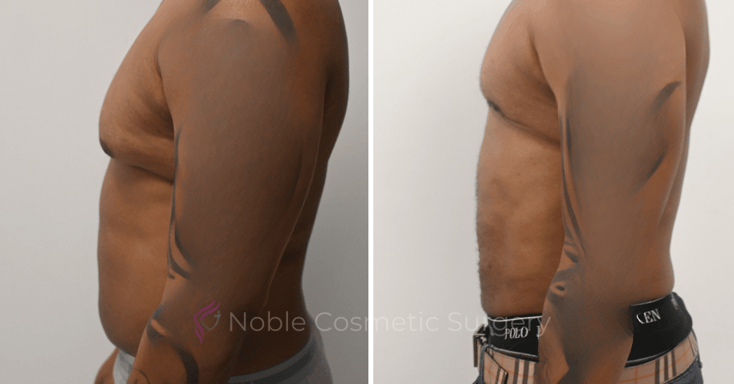 GYNECOMASTIA-CASE-10270 | Before and After Gynecomastia 5