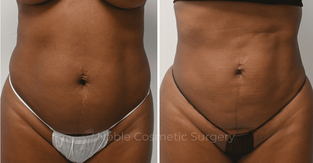 LIPOSUCTION-CASE-10510 | Before and After Liposuction