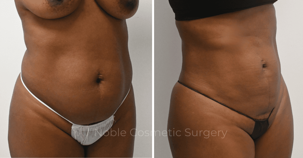 LIPOSUCTION-CASE-10510 | Before and After Liposuction 2