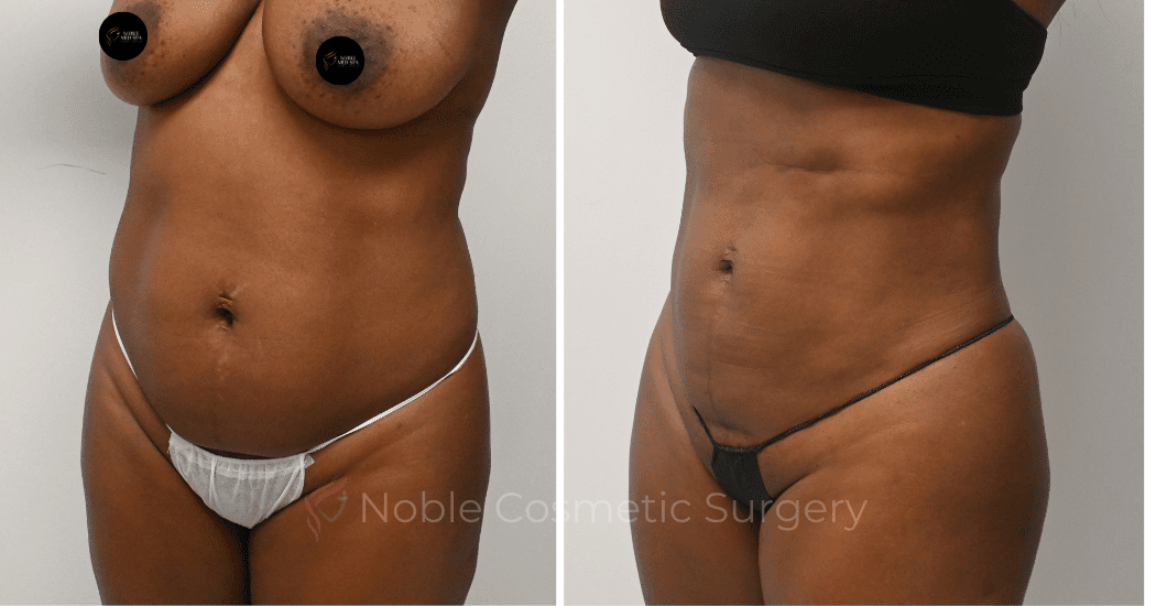 LIPOSUCTION-CASE-10510 | Before and After Liposuction 3