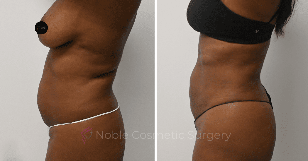 LIPOSUCTION-CASE-10510 | Before and After Liposuction 4