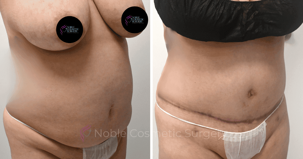 TUMMY-TUCK-CASE-10538 | Before and After Abdominoplasty 2