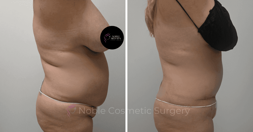 TUMMY-TUCK-CASE-10538 | Before and After Abdominoplasty 3