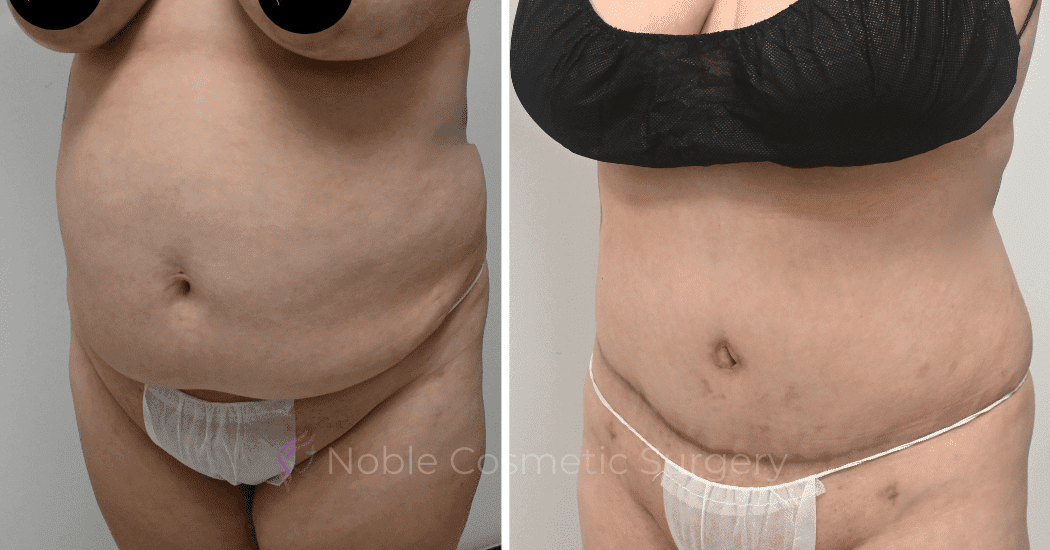 TUMMY-TUCK-CASE-10538 | Before and After Abdominoplasty 4