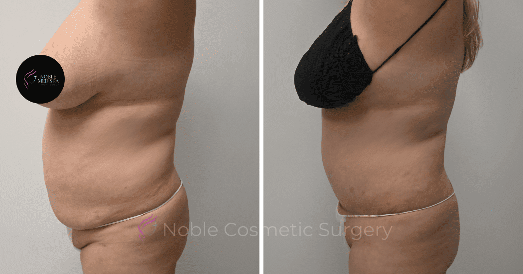 TUMMY-TUCK-CASE-10538 | Before and After Abdominoplasty 5