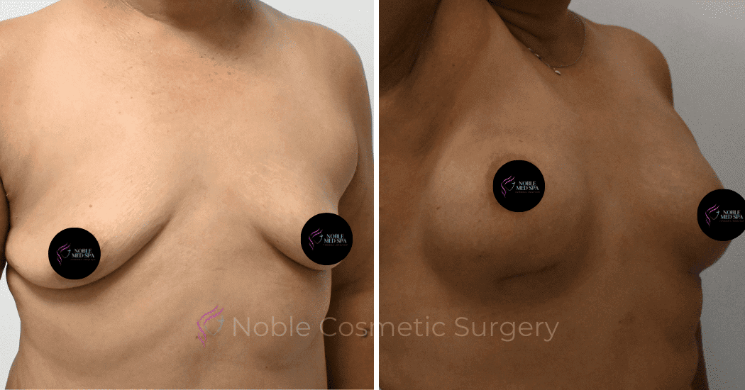 BREAST-AUGMENTATION-CASE-10545 | Before and After Breast Augmentation 2