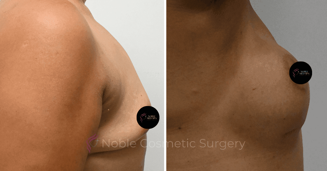 BREAST-AUGMENTATION-CASE-10545 | Before and After Breast Augmentation 3