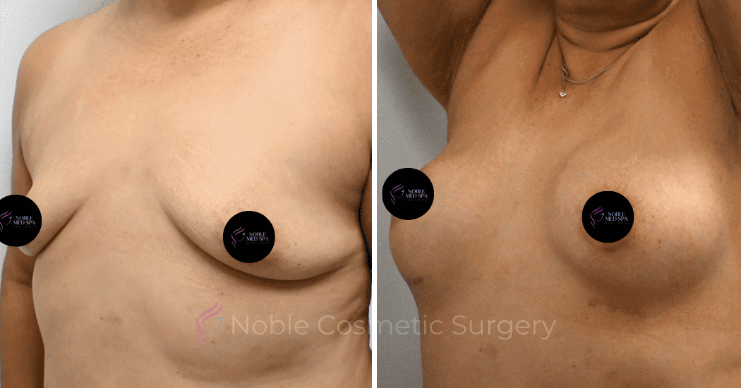 BREAST-AUGMENTATION-CASE-10545 | Before and After Breast Augmentation 4