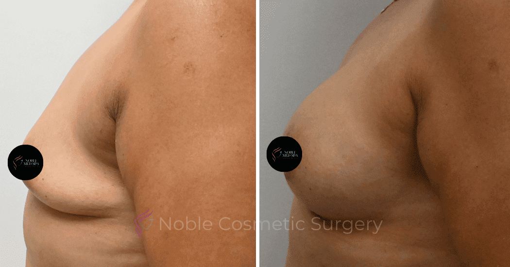 BREAST-AUGMENTATION-CASE-10545 | Before and After Breast Augmentation 5