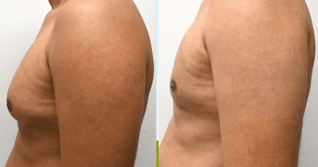 GYNECOMASTIA-CASE-10707 | Before and After Gynecomastia 4