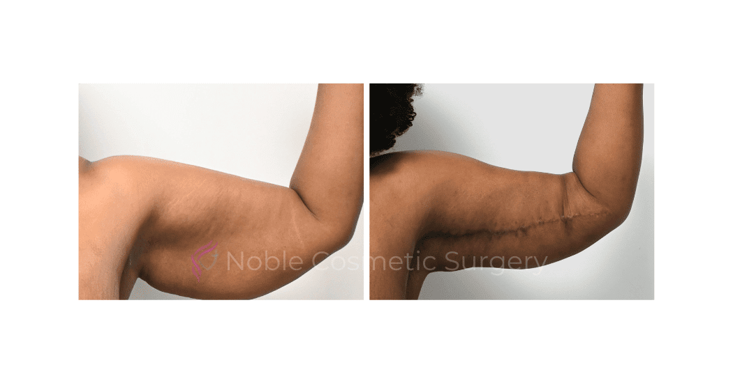 ARM-LIFT-CASE-10784 | Before and After Brachioplasty