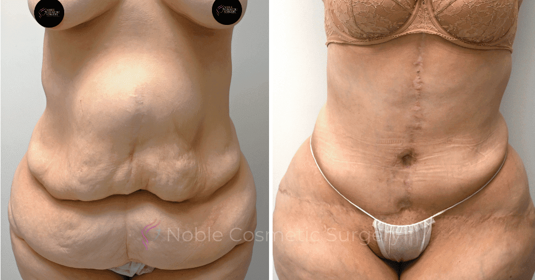 TUMMY-TUCK-CASE-10950 | Before and After Abdominoplasty
