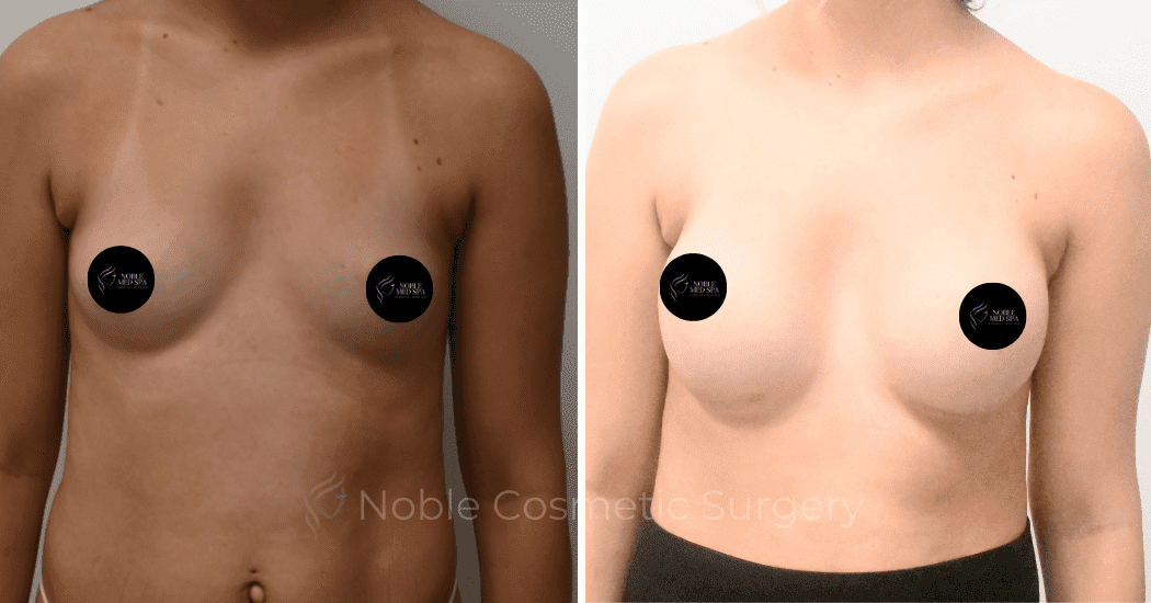 BREAST-AUGMENTATION-CASE-11094 | Before and After Breast Augmentation