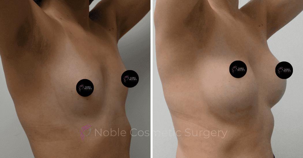 BREAST-AUGMENTATION-CASE-11094 | Before and After Breast Augmentation 2