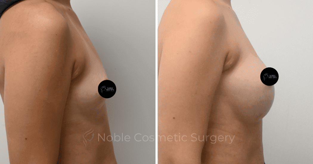 BREAST-AUGMENTATION-CASE-11094 | Before and After Breast Augmentation 3