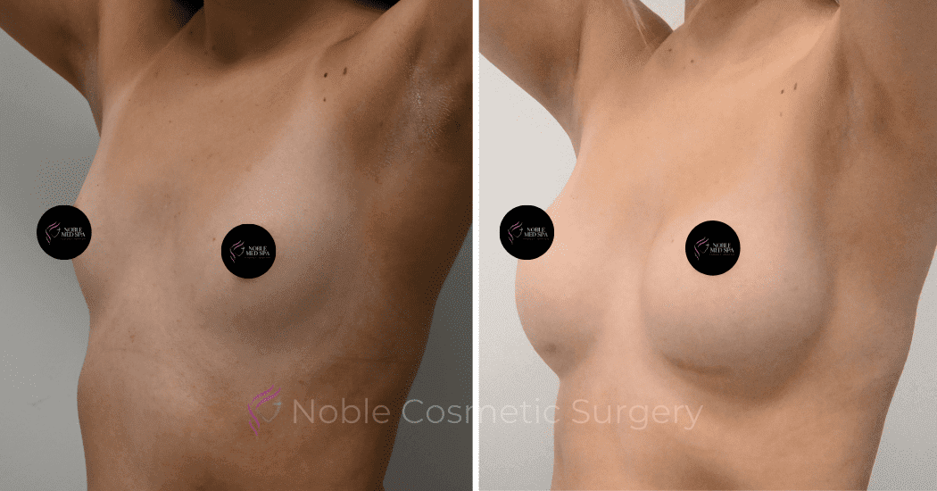 BREAST-AUGMENTATION-CASE-11094 | Before and After Breast Augmentation 4