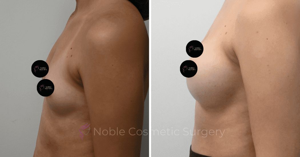 BREAST-AUGMENTATION-CASE-11094 | Before and After Breast Augmentation 5