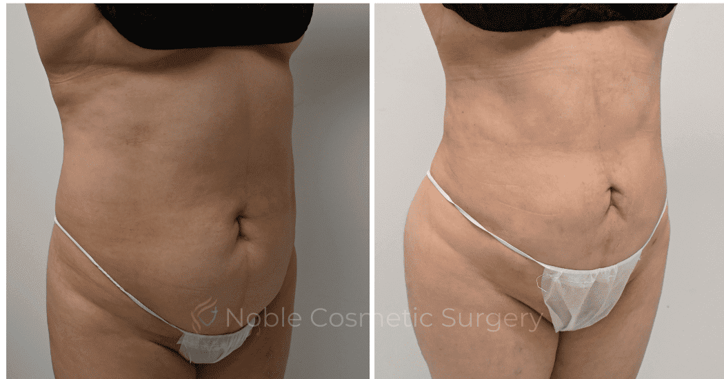 LIPOSUCTION-CASE-11116 | Before and After Liposuction 2