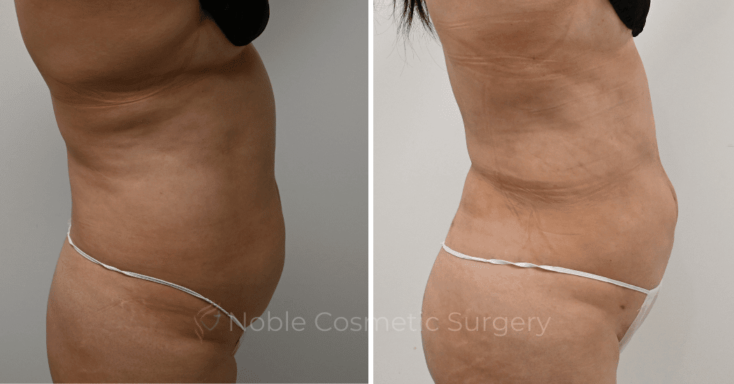LIPOSUCTION-CASE-11116 | Before and After Liposuction 3