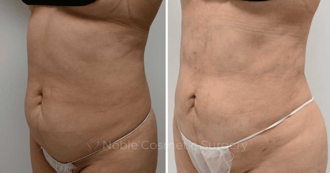 LIPOSUCTION-CASE-11116 | Before and After Liposuction 4