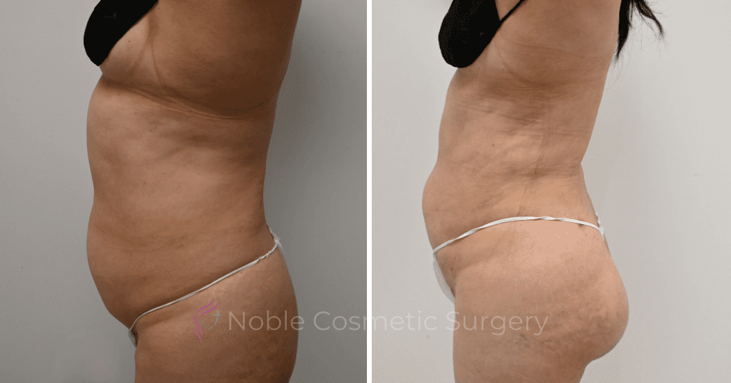 LIPOSUCTION-CASE-11116 | Before and After Liposuction 5