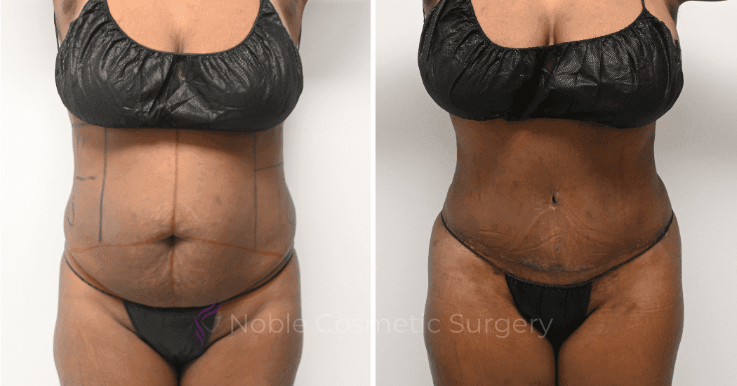 TUMMY-TUCK-CASE-11298 | Before and After Abdominoplasty 1