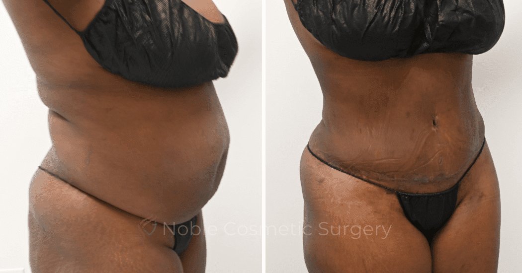 TUMMY-TUCK-CASE-11298 | Before and After Abdominoplasty 2