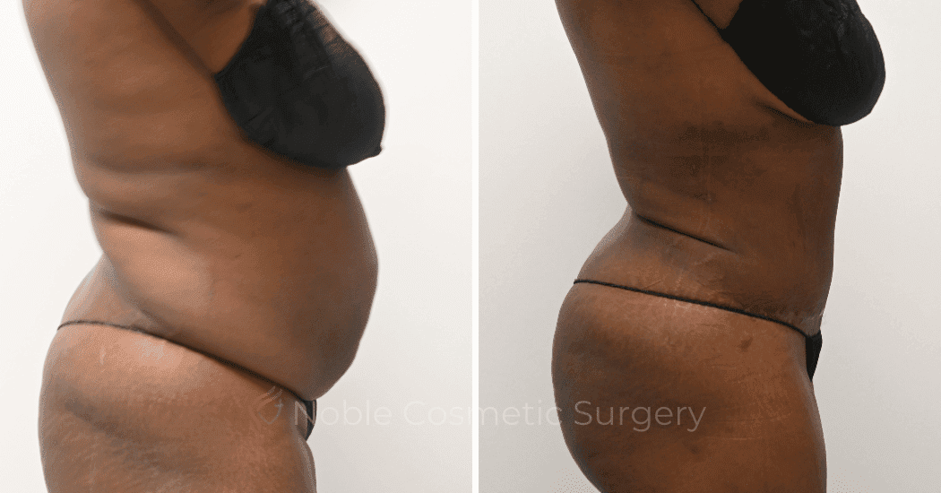 TUMMY-TUCK-CASE-11298 | Before and After Abdominoplasty 3