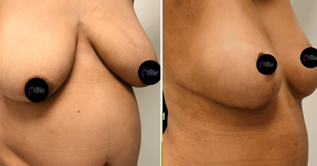 BREAST-REDUCTION-CASE-11303 | Before and After Breast Reduction 2