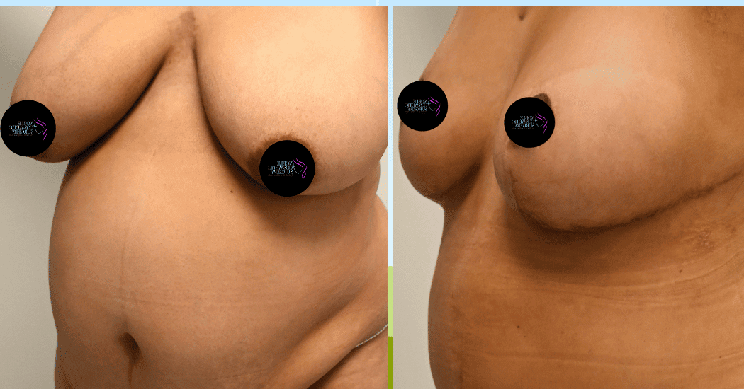 BREAST-REDUCTION-CASE-11303 | Before and After Breast Reduction 3