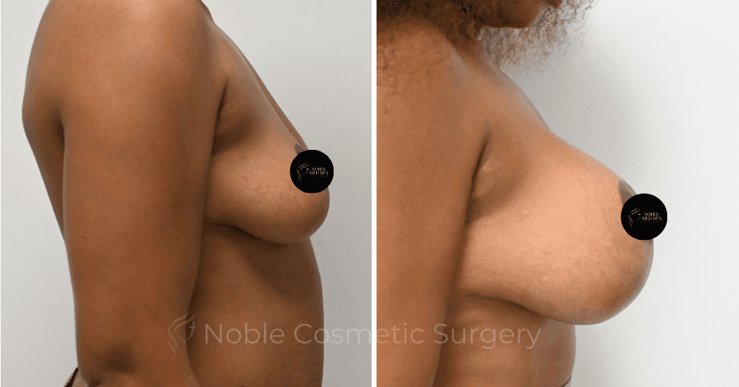 BREAST-AUGMENTATION-CASE-11356 | Before and After Breast Augmentation 3