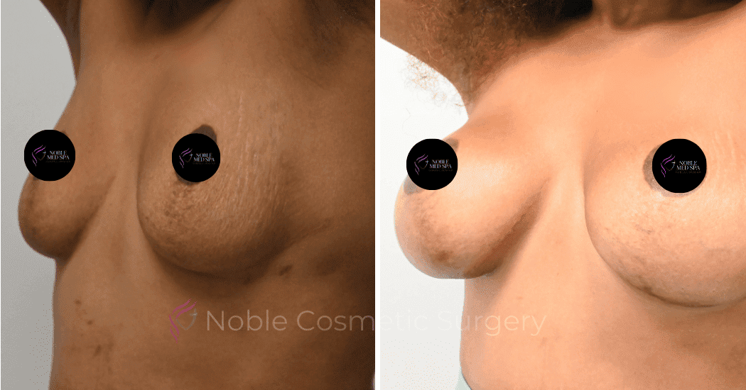 BREAST-AUGMENTATION-CASE-11356 | Before and After Breast Augmentation 4