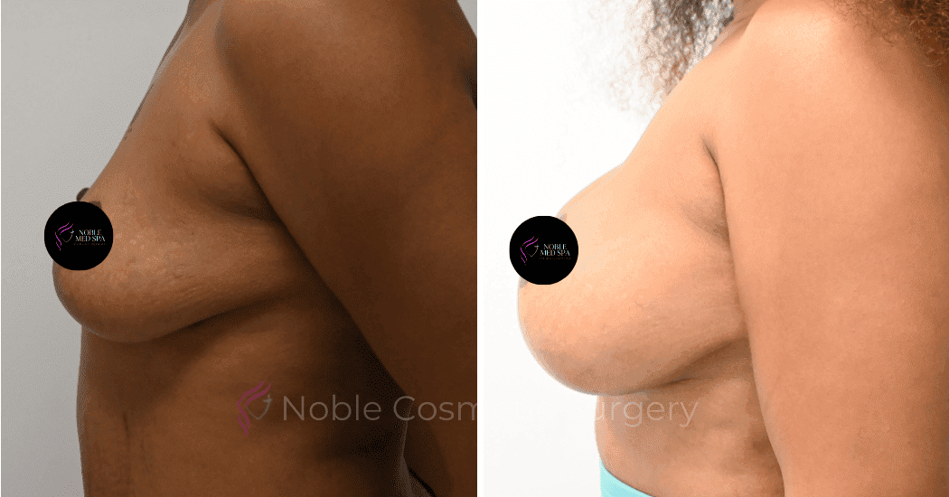BREAST-AUGMENTATION-CASE-11356 | Before and After Breast Augmentation 5