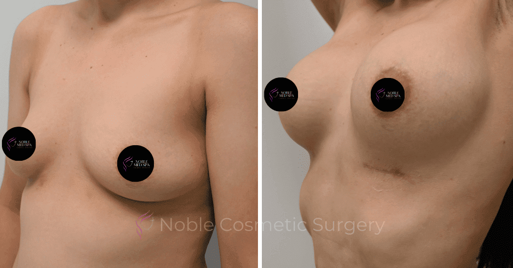 BREAST-AUGMENTATION-CASE-11661 | Before and After Breast Augmentation 3