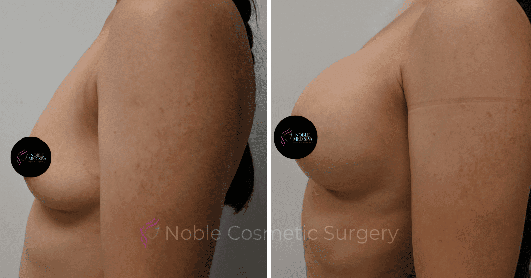 BREAST-AUGMENTATION-CASE-11661 | Before and After Breast Augmentation 4