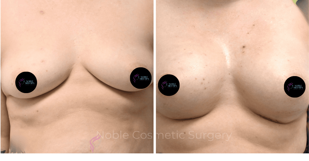 BREAST-AUGMENTATION-CASE-11771 | Before and After Breast Augmentation