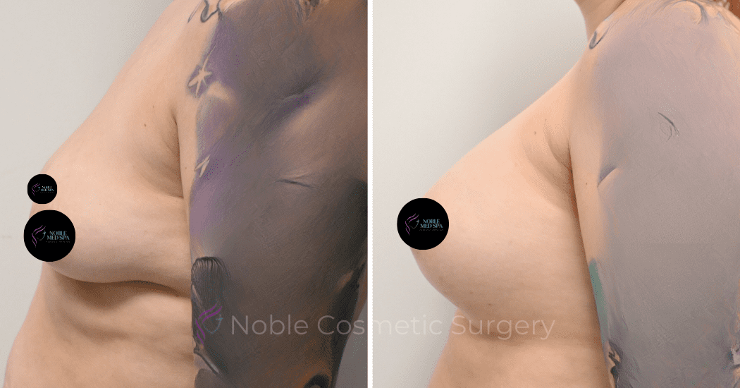 BREAST-AUGMENTATION-CASE-11771 | Before and After Breast Augmentation 5