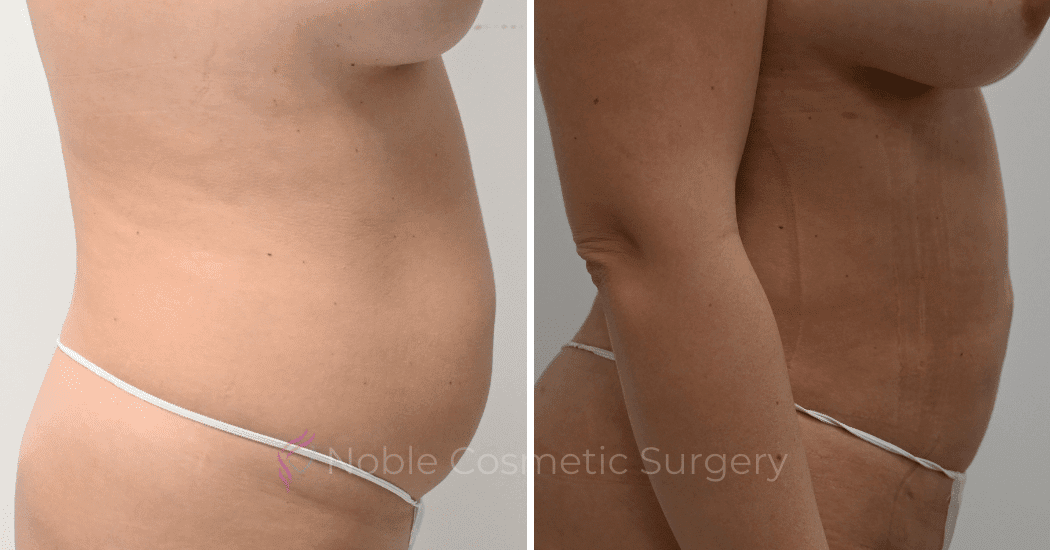 LIPOSUCTION-CASE-11801 | Before and After Liposuction 3