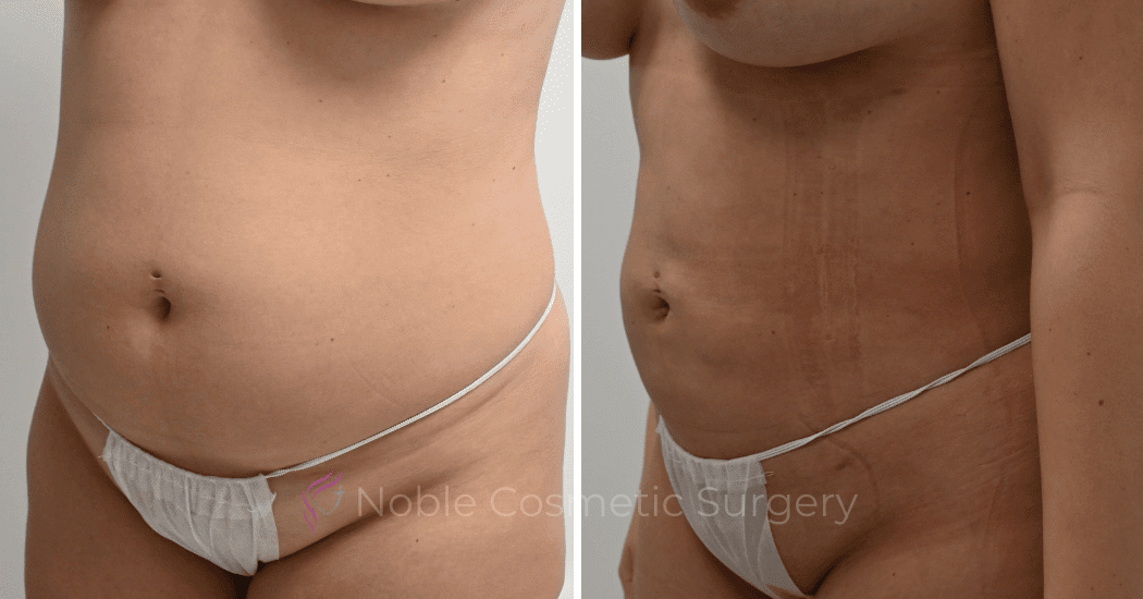 LIPOSUCTION-CASE-11801 | Before and After Liposuction 4