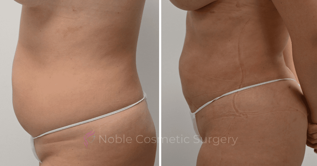 LIPOSUCTION-CASE-11801 | Before and After Liposuction 5