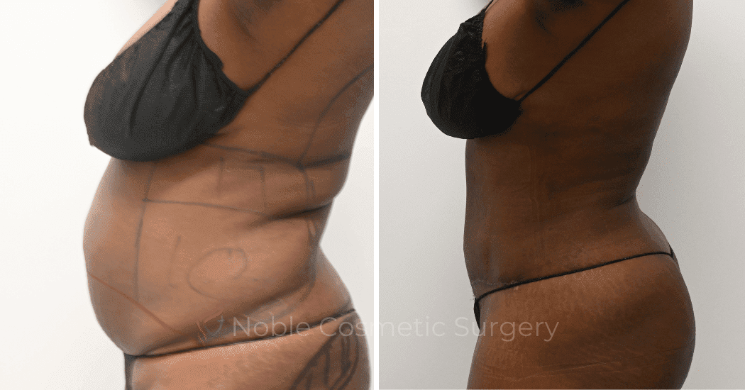 TUMMY-TUCK-CASE-11298 | Before and After Abdominoplasty 5
