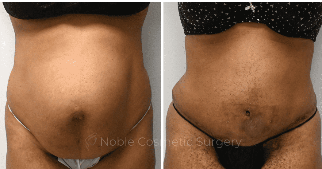 TUMMY-TUCK-CASE-11974 | Before and After Abdominoplasty