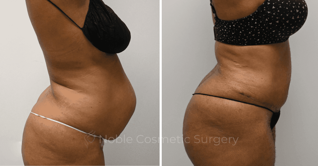 TUMMY-TUCK-CASE-11974 | Before and After Abdominoplasty 2