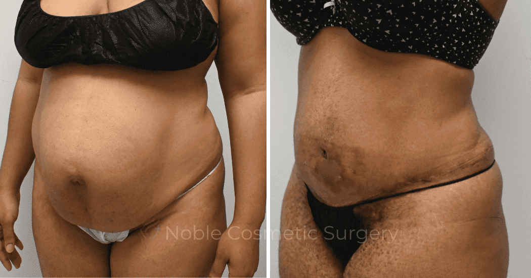 TUMMY-TUCK-CASE-11974 | Before and After Abdominoplasty 3