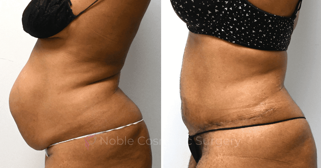 TUMMY-TUCK-CASE-11974 | Before and After Abdominoplasty 4