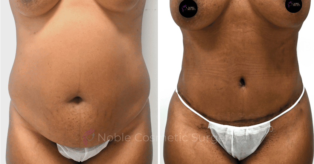 TUMMY-TUCK-CASE-12002 | Before and After Abdominoplasty