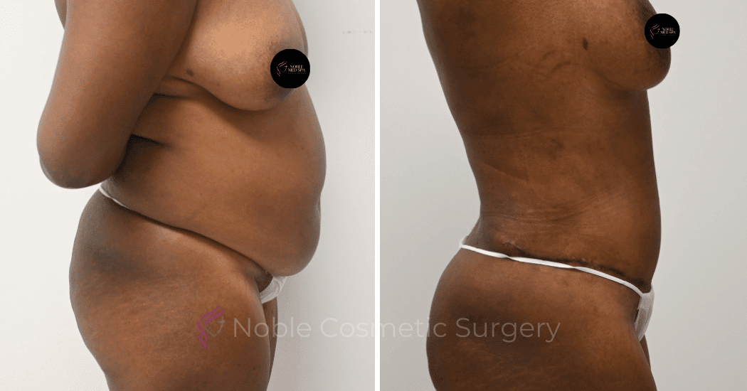 TUMMY-TUCK-CASE-12002 | Before and After Abdominoplasty 2