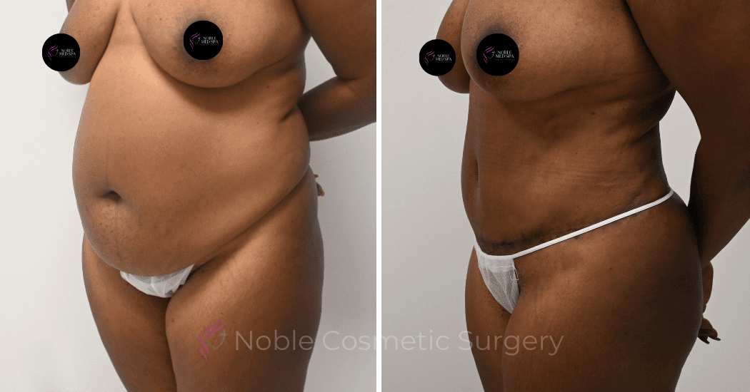 TUMMY-TUCK-CASE-12002 | Before and After Abdominoplasty 3