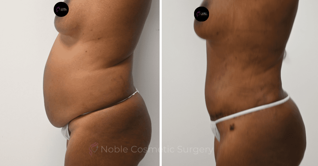 TUMMY-TUCK-CASE-12002 | Before and After Abdominoplasty 4