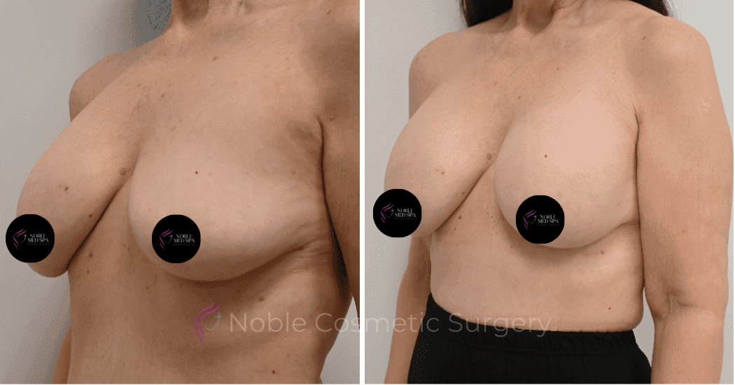 BREAST-AUGMENTATION-CASE-12085 | Before and After Breast Augmentation 3